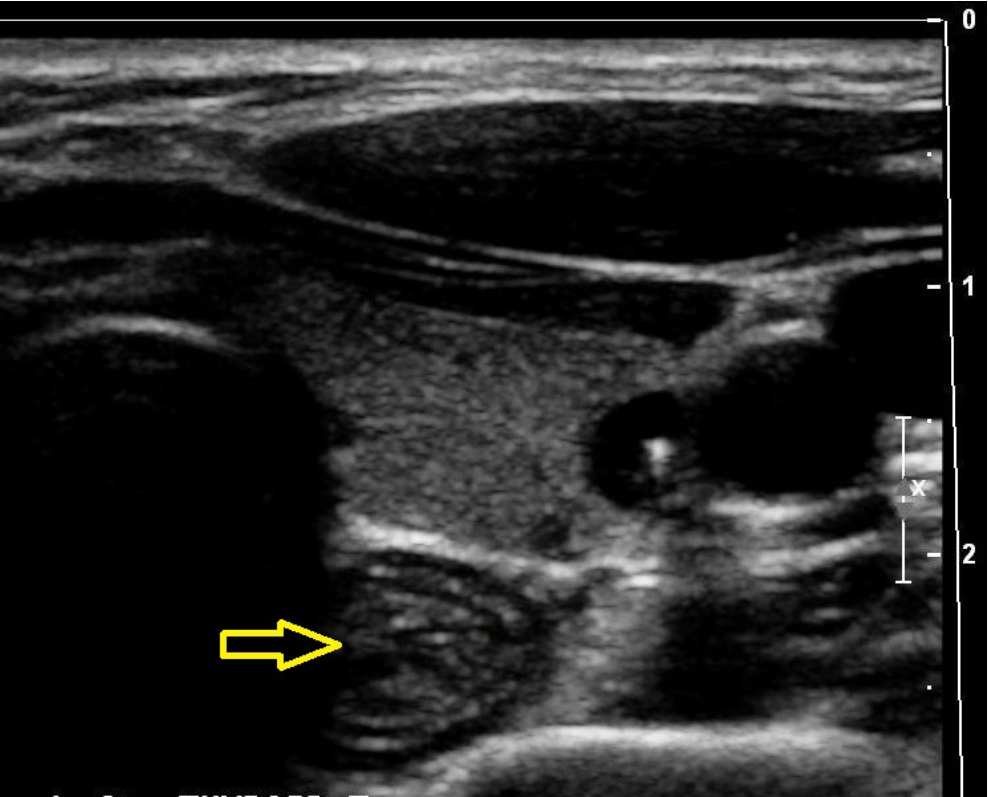 <p>What is indicated by the yellow arrow?</p><p>A. parathyroid adenoma</p><p class="p1">B. longus colli muscle</p><p class="p1">C. esophagus</p><p class="p1">D. trachea</p>