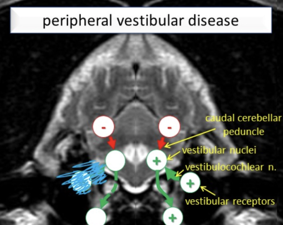 <p>PEN</p><ol><li><p><strong>Postural and Gait Abnormalities</strong> = Head tilt, rolling/falling/tight circling, vestibular ataxia, wide-based stance with lowered centre of gravity</p></li><li><p><strong>Abnormal Eye Movements</strong></p><ol><li><p><u>Spontaneous/resting nystagmus</u> = Brain triggers nystagmus as it thinks the head is turning (pathological)</p><ul><li><p>Horizontal OR vertical with fast phase in one direction and slow phase in the opposite</p></li><li><p><strong>Pendular nystagmus</strong> = Spontaneous nystagmus in normal, blue-eyed cats due to abnormal proportion of optic nerve axons crossing the optic chiasm (no lateralisation)</p></li></ul></li><li><p><u>Positional nystagmus</u> = Head position must be changed to trigger pathological nystagmus</p></li><li><p><u>Positional strabismus</u> = Abnormal position of eye within orbit due to change in head position</p><ul><li><p>NORMAL: Gaze remains central when head and neck extend dorsally (vs. horses)</p></li><li><p>Loss of vestibular function: Extraocular muscles on affected side fail to maintain central gaze → Ventral positional strabismus of affected side</p></li><li><p><strong>Static strabismus</strong> = Abnormal eye position at ALL times (due to orbit conformation or mechanical dysfunction of the extraocular muscles)</p></li></ul></li></ol></li></ol><img src="https://assets.knowt.com/user-attachments/cc7df1d8-5f2b-48d5-9d7f-7cde65bc3df3.png" data-width="50%" data-align="center"><ol start="3"><li><p><strong>Nausea</strong></p></li></ol><p></p><p><u>Pathogenesis:</u></p><ol><li><p>Pathological lesion → Loss of input from vestibular receptors/loss of vestibular nuclei function on ONE side</p></li><li><p>→ Less vestibular activity on that side</p></li><li><p>→ Comparatively more vestibular activity on the CONTRALATERAL side</p></li><li><p>Brain cannot differentiate between an imbalanced vestibular system due to turning OR pathology → Normal vestibular stimulation results in ABNORMAL posture and movements</p></li><li><p>→ Increased extensor muscle tone on side of greater activity</p></li><li><p>BUT because the animal is NOT turning, it causes them to lean/fall/circle/roll towards side of lesser vestibular activity</p><ul><li><p>Tight circling to due stumbling and falling off balance</p></li></ul></li><li><p>Increased extensor tone of neck on side of greater activity pushes the head to the other side causing head tilt TOWARDS the side of less vestibular activity</p></li></ol><img src="https://assets.knowt.com/user-attachments/d802eeaf-ddb0-4891-af29-e93bd28b073e.png" data-width="100%" data-align="center"><p></p>