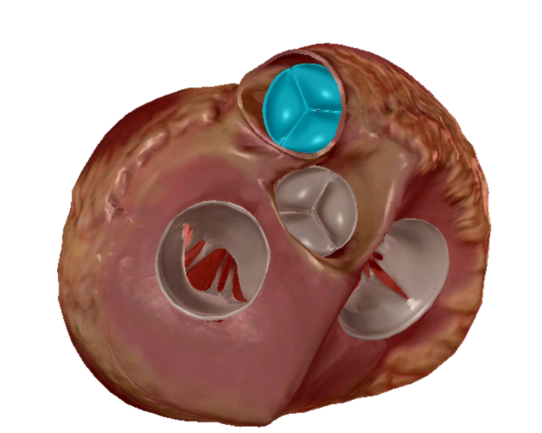 <p>right ventricle to pulmonary arteries </p>