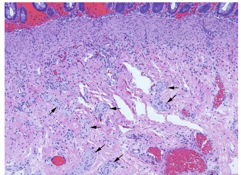 <p>in hirschsprung disease</p>