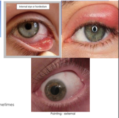 <p>-pain and tenderness</p><p>-eyelid swelling and redness of the lid</p><p>-visible or palpable subcutaneous nodule, sometimes pointed</p>