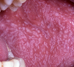 <p><span>papules</span></p>