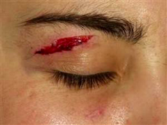<p>- Superficial lacerations: suture with 6-0 nylon </p><p>- Significant laceration warrants ophthalmology consult</p>