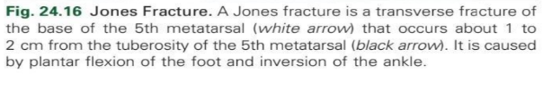 <p>Jones fracture</p>