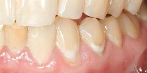 <p>Define Incipient caries</p>
