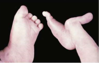 <p>Lobster claw deformity</p>