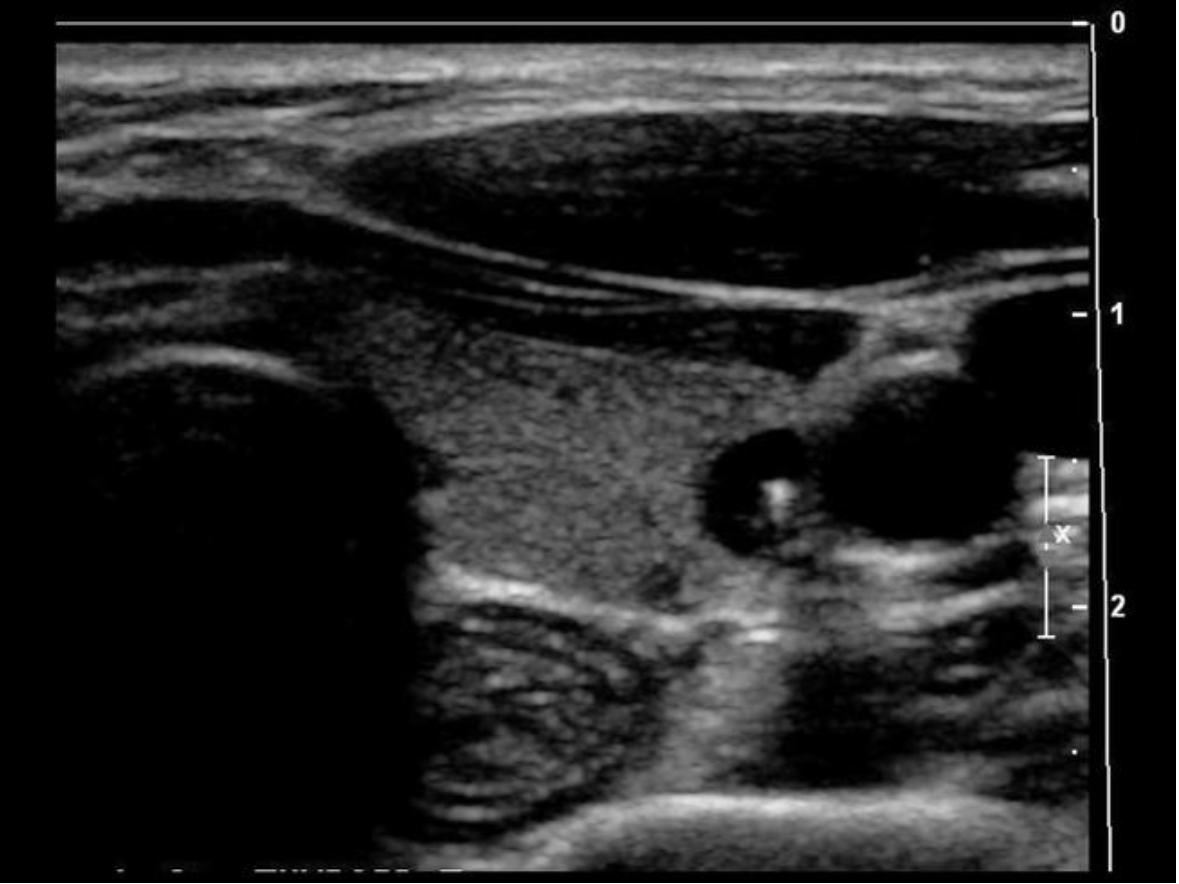 <p>Find the internal jugular vein</p>