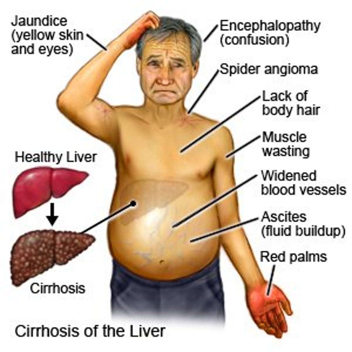 <p>B) Jaundice, ascites, varices, encephalopathy, and coagulopathy</p>