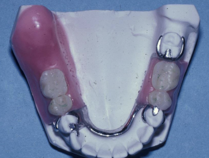 <p>What are your reline options for removable partial dentures?</p>