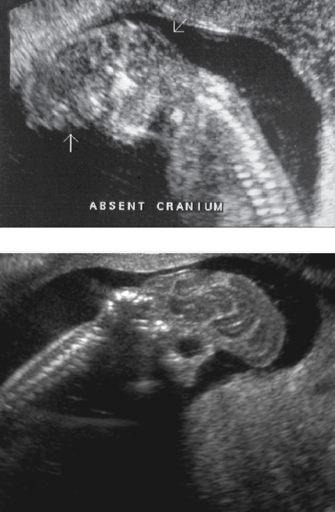 <p>The presence of brain tissue without the presence of cranial bones</p>