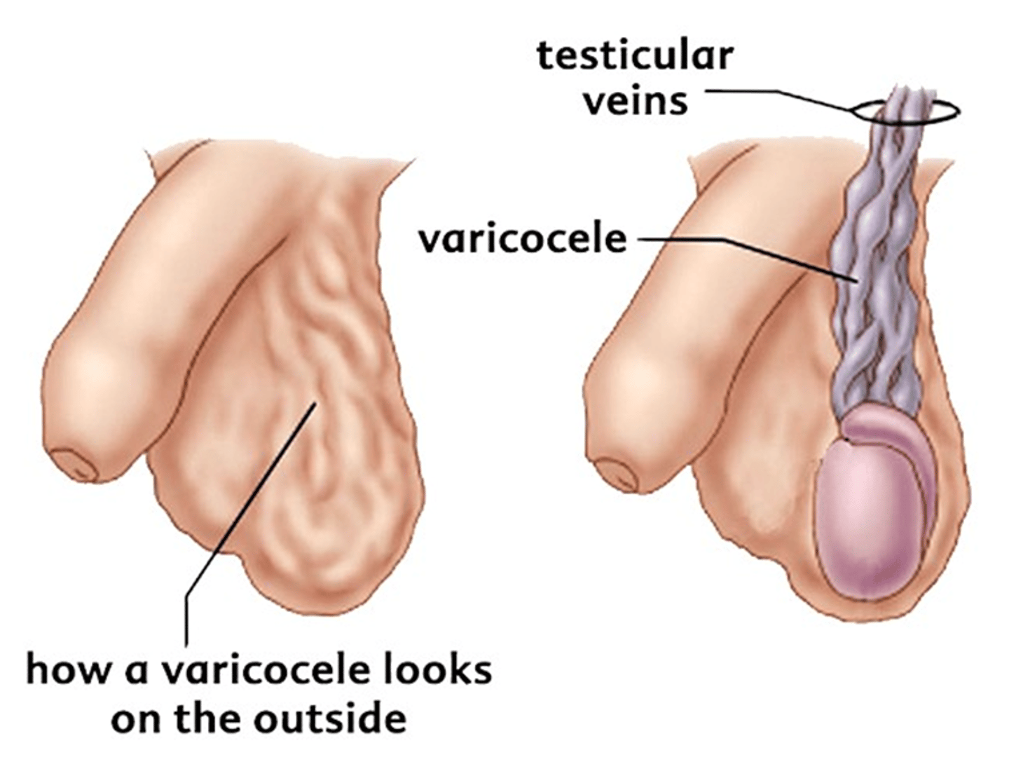 <p>"bag of worms" appearance that increases with valsalva</p>