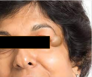 <p>A 35 year presented with cystic swelling on lateral part of forehead of 2 cm diameter. Provide DD</p>