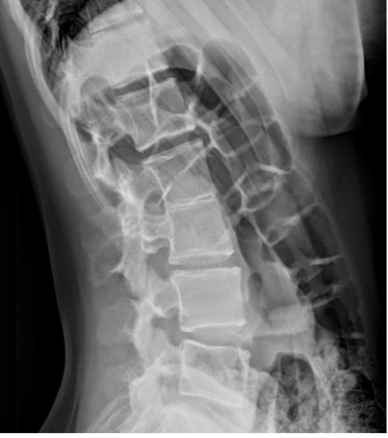 <p>Adjacent vertebra osseously fused from birth; associated with wasp waist and hypoplastic disc </p>
