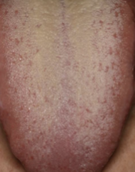 <ol start="32"><li><p>Identify the finding shown.</p></li></ol><p></p>