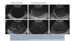 <p>The contents of Anovulatory follicles may range from uniformly ____ to ____ appearance.</p>