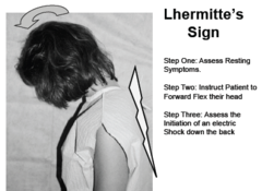 <p>Low Vit D, stress? --> destruction of myelin in UMNs in brain and spinal cord --> slow nerve impulses --> weakness, stiffness of muscles, abnormal gait, slurred speech, diplopia, sharp/tingling sensation down back/legs when flexing neck (Lhermitte's sign)</p>