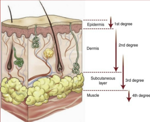 <p><u>SE:</u> loss of skin function caused by source, heat intensity, exposure duration, skin thickness, plasma loss (55% of blood volume, 90% water)</p><p><strong><u>major burns (>20% total body surface area </u></strong><u>TBSA):</u></p><ul><li><p><u>fluid imbalance:</u> inflammation, edema, redness, turns systemic ASAP, vasodilation, capillary permeability, fluid loss</p></li><li><p><u>hemodynamic changes:</u> cardiac output decreases, SNS response (stress) → hypermetabolism (up to 1 yr) + hyperglycemia</p></li></ul><p></p><p>types:</p><p><u>thermal (common):</u> contact, steam, flame, scalding liquids</p><p><u>chemical:</u> contact, fumes, ingestion, injection. depends on chemical concentration + volume</p><ul><li><p>household cleaners</p></li></ul><p><u>electrical (high vs low volt):</u> entry + exit points, cardiac + renal concerns. dysrhythmias due to electricity.</p><ul><li><p>electrical wires, poles, lightning</p></li></ul><p><u>inhalation:</u> from thermal or chemical agents</p><ul><li><p>environment, work</p></li></ul><p><u>radiation:</u> </p><p></p><p>burn depth: <strong>(11th, p 467 table 21.8)</strong></p><p><u>superficial thickness (1st degree):</u> thru epidermis. </p><ul><li><p><u>SE:</u> nerve damage, <strong>feels pain when burnt, redness, blanchable</strong></p></li></ul><p><u>partial thickness (2nd degree):</u> past epidermis and into dermis.</p><ul><li><p>superficial partial thickness: halfway thru dermis</p></li><li><p>deep partial thickness: fully thru dermis</p></li><li><p><u>SE:</u> nerve damage, <strong>feels pain when burnt, blistered, moist</strong></p></li></ul><p><u>full thickness (3rd degree):</u> thru epidermis, dermis, and SQ tissue. difficulty healing, needs grafts. </p><ul><li><p><u>SE:</u> <strong>pain cannot be felt in this layer because nerves are not in SQ. pain only felt in less burnt areas, dry, discolored. leathery or charred.</strong></p></li></ul><p><u>deep full-thickness (4th degree):</u> thru epidermis, dermis, SQ, and muscle, sometimes to bone. cannot heal, grafts don’t help, needs amputation</p><ul><li><p><u>SE:</u> <strong>same as full thickness</strong></p></li></ul><p></p>