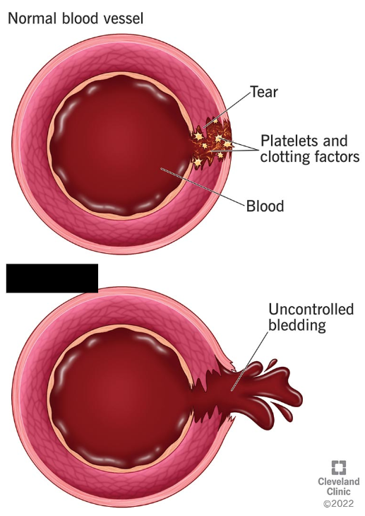 <p><span style="background-color: transparent;">A recessive genetic disorder that impairs the blood's ability to clot. This causes unexpected and prolonged bleeding, bruises, and pain in joints. There is no cure, but transfusions with healthy clotting factors can be administered.</span></p>