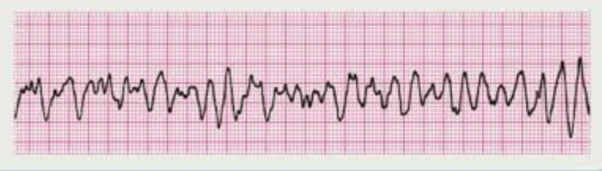 <p><span>The nurse observes the following rhythm in a client. What is the appropriate identification for this rhythm?</span></p>