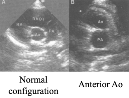 <ul><li><p>Dx when the <span style="color: rgb(0, 118, 255);">Ao</span> is <span style="color: rgb(255, 0, 255);">anterior</span> to the <span style="color: rgb(255, 0, 255);">Pulm A</span></p><ul><li><p>PSAX</p></li></ul></li></ul><p></p>