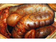 <p>You would expect pig intestines to look like this if they were survivors of WHAT disease?</p>