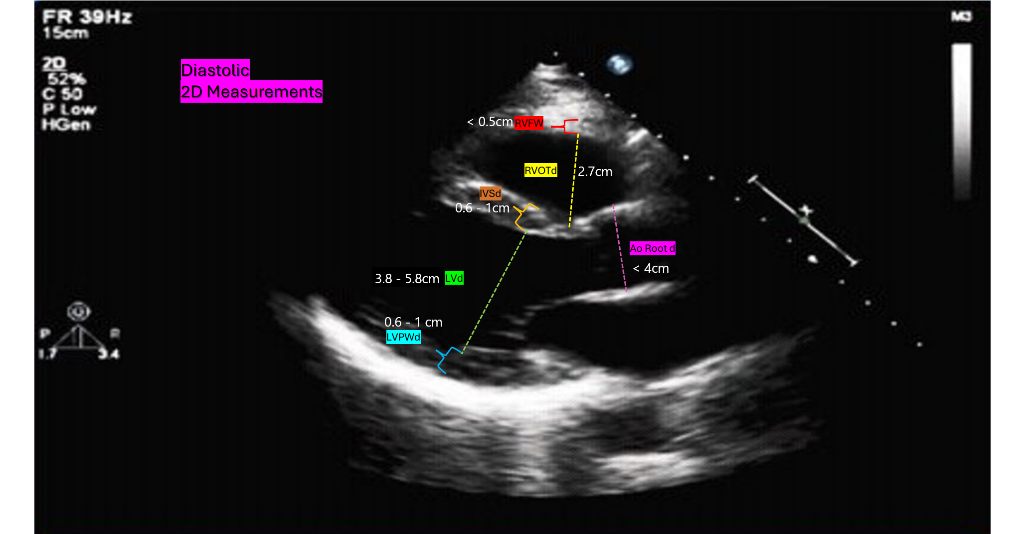 <p>LVd (Left Ventricule diastole) 3.8 - 5.8cm</p>