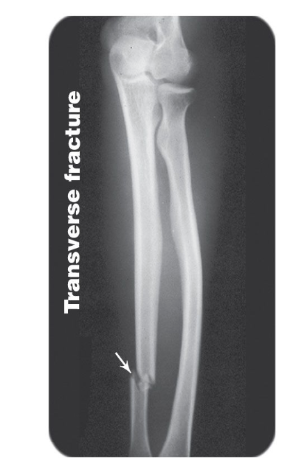 <p>break goes <strong>straight</strong> across the bone, broke in half along horizontal axis</p>