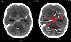 <p>In the subarachnoid space.</p><p>Usually as a rupture of a 'berry' aneurysm at the base of the brain. ~85% are anterior circle of Willis, ~15% vertebrobasilar.</p><p>Sudden, very severe "thunderclap" headache. Nausea, vomiting, stiffness.</p><p>Can either surgically clip, or endovasular embolisation.</p>