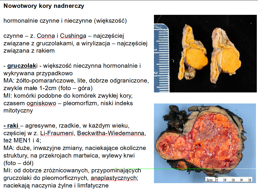<p>c. Gruczolak kory nadnercza. </p>