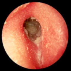 <p>Otitis Externa</p>