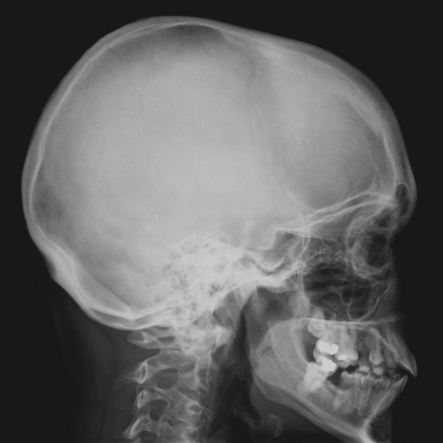 <p>What does the lateral skull demonstrate?</p>