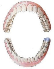 <p>mandibular left third molar</p>