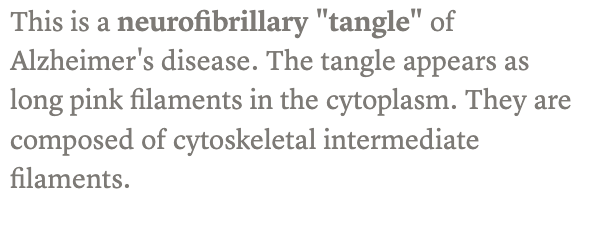 <p><span><strong>Ovillos neurofibrilares</strong></span></p>