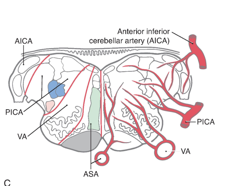 <p>Lateral medullary (Wallenberg) syndrome. A normal magnetic resonance image (MRI, T2 weighted) (A) shows the vertebral and posterior inferior cerebellar arteries in relation to the medulla. The patient whose MRI is shown in (B) (MRI, T2 weighted) had an occlusion of the <em>PICA, </em>which resulted in an infarct of the territory of the medulla served by this vessel. The structures damaged in this lesion are shown in (C). Compare with Fig. 11.16 .</p><p></p><p>In addition to this broad expanse of the medulla, branches of the PICA also serve the choroid plexus of the fourth ventricle. At the pons-medulla junction, the cochlear nuclei and a small adjacent part of the restiform body are served by branches of the <strong>anterior inferior cerebellar artery </strong>( Fig. 11.16C ).</p>