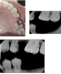 <p>What is the treatment for #14?</p><p>Findings:</p><p>- Visual: Occlusal-MOB Amalgam-OK</p><p>- Radiographic: D- Advanced</p>