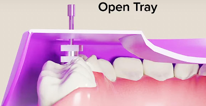 <p>Open-tray technique </p>