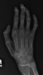 <p>easier to penetrate i.e. osteoporosis</p>