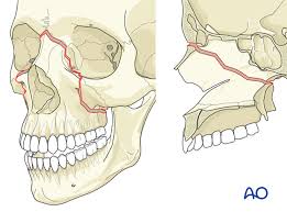 <p>created by direct blows and propagate triangularly across the maxilla, orbital floors, and nasal bones</p>