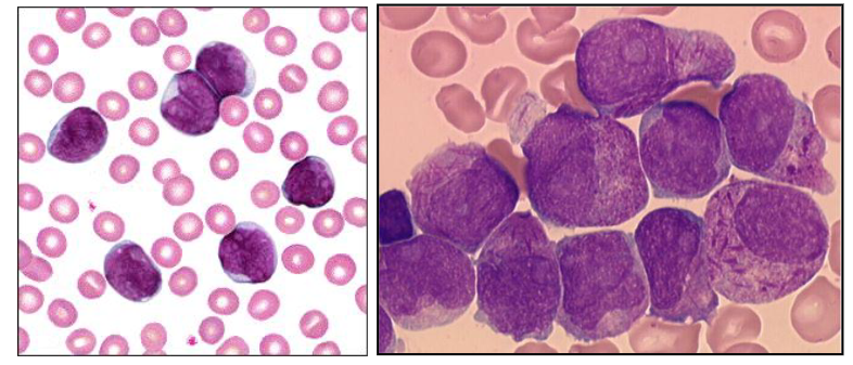 <p>- on the left is Acute Lymphoblastic Leukaemia</p><p>- On the right is Acute Myeloid Leukaemia</p>