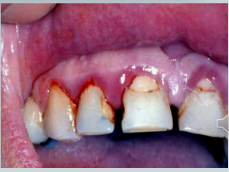 <ul><li><p>reparative responses include<strong> granulation tissue formation </strong>(vascular <strong><u>immature </u></strong>connective tissues) and <strong>fibrosis </strong>(<u>scarring</u>) </p></li><li><p>regulated by cytokines such as<strong> IL-1, TNF-α</strong> and many others </p></li><li><p>In <strong>gingivitis</strong>, tissue damage is typically in <strong>balance </strong>with tissue repair, in perio the balance is favoured at damage (but repair still happens)</p></li></ul><p></p>