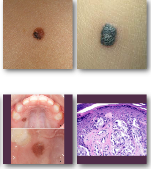 <ul><li><p>more common in children</p></li></ul><p></p>