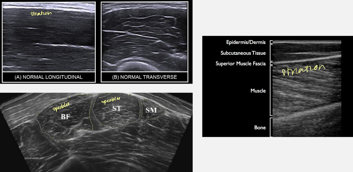 <ul><li><p>muscles are voluntary or involuntary (controlled by Autonomic Nervous System)</p></li><li><p>3 types: skeletal; smooth; cardiac</p><ul><li><p>skeletal: controlled through the nervous system; attached to bones</p></li><li><p>cardiac: smooth muscle involving the heart; involuntary</p></li><li><p>smooth: attached to internal organs and muscles surrounding the blood vessels</p></li></ul></li><li><p>SONO: </p><ul><li><p>hypoechoic with linear, echogenic strands/striations when imaged SAG</p></li><li><p>speckled “starry night” appearance when imaged TRV</p></li></ul></li></ul><p></p>