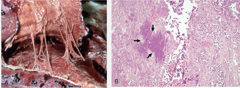 <p> As vascular permeability increases, fibrinogen can pass the vascular barrier</p><p>and fibrin is formed and deposited in the extravascular space</p><p></p><p>• The pleural surfaces are covered by a yellow-grey, thick, friable exudate</p><p>consisting of fibrin mixed with other plasma proteins. This exudate can be</p><p>easily pulled apart and should not be confused with fibrous adhesions.</p><p></p><p>• Microscopically, there are layers of homogeneous eosinophilic material</p><p>(fibrin) that contain occasional neutrophils and a focus of bacteria (arrows).</p>