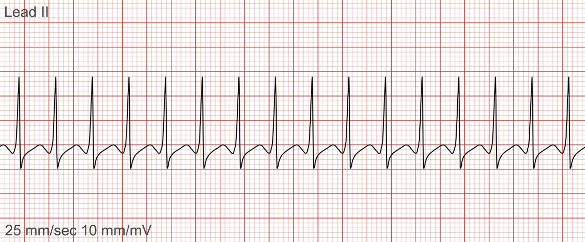 <p>the image shown depicts what cardiac arrhythmia?</p>