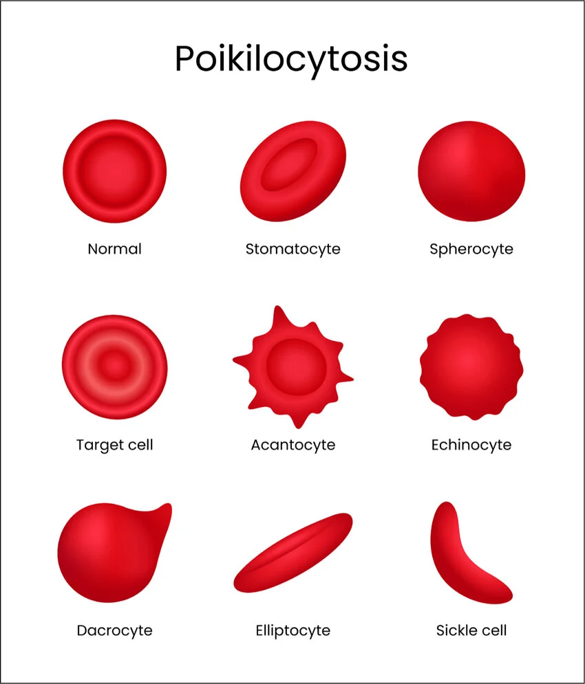 <p>Distorted RBC shape in 10% or more of RBCs</p><p>Poikilo: Variable</p><p></p><p>Causes</p><ul><li><p>Sickle cell anemia→ crescent shaped</p></li><li><p>Thalassemia→ bullseye shape</p></li><li><p>Myelofibrosis (scar tissue buildup in BM)→ tear drop</p></li><li><p>Iron deficiency→ oval, elonagated cells</p></li><li><p>Mechanical damage→ fragmented cells</p></li></ul><p></p>