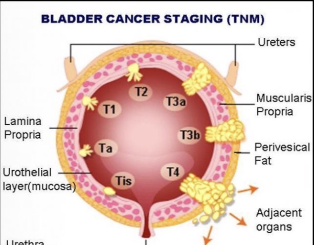 <p>T= Tumour</p>