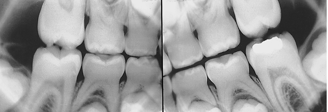 <p>Dentin Dysplasia ( Type II: Coronal) </p>