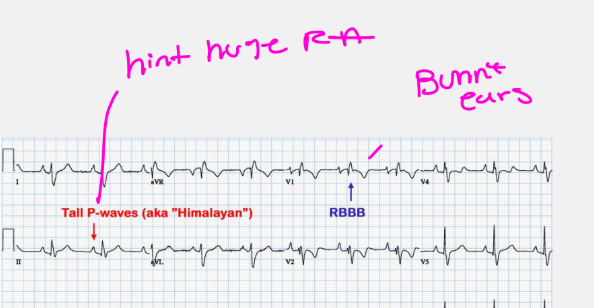 <ul><li><p>Wolff-Parkinson-White syndrome in approximately <strong>30%**</strong></p></li><li><p>Right bundle branch block in approximately <strong>90%** (the bunny ears)</strong></p></li><li><p>(Pre-excitation, Tall P waves from RA enlargement, called <strong>Himalayan P waves, </strong>Prolonged PR interval, & Atrial fibrillation or atrial flutter)</p></li></ul><p></p>