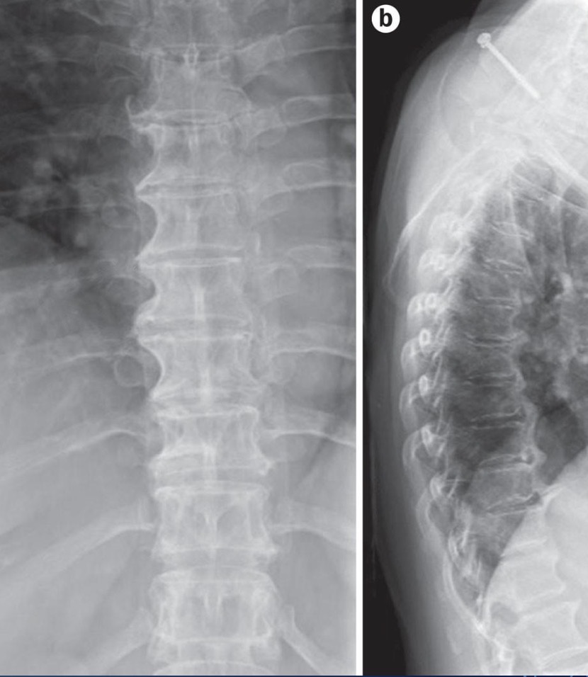 <ul><li><p>Flowing, bridging osteophytes - typically anterior + right side</p></li><li><p>Requires 4 or more connecting vertebrae</p></li><li><p></p></li></ul><p></p>