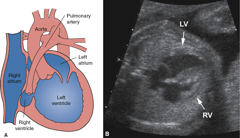 <p>Absent or small right ventricle</p><p>Enlarged left ventricle</p><p>Fetal hydrops (secondary to cardiac failure)</p><p>Narrowing of the pulmonary valve</p>